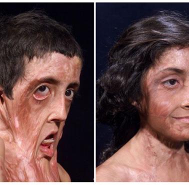 Rekonstrukcja twarzy ofiary poparzenia
